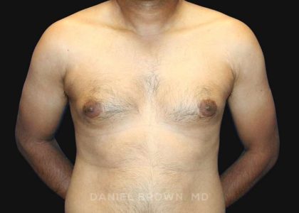 Gynecomastia Before & After Patient #10143