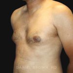 Gynecomastia Before & After Patient #10143