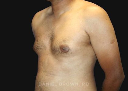 Gynecomastia Before & After Patient #10143