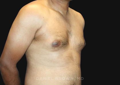 Gynecomastia Before & After Patient #10143