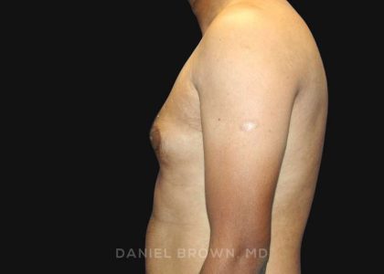 Gynecomastia Before & After Patient #10143
