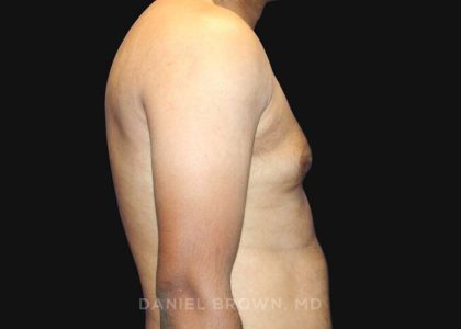 Gynecomastia Before & After Patient #10143