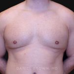 Gynecomastia Before & After Patient #10154