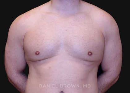Gynecomastia Before & After Patient #10154