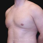 Gynecomastia Before & After Patient #10154