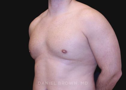Gynecomastia Before & After Patient #10154