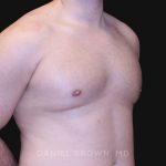 Gynecomastia Before & After Patient #10154