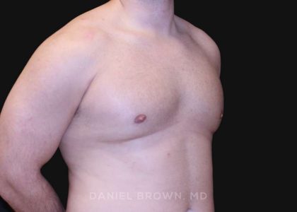 Gynecomastia Before & After Patient #10154
