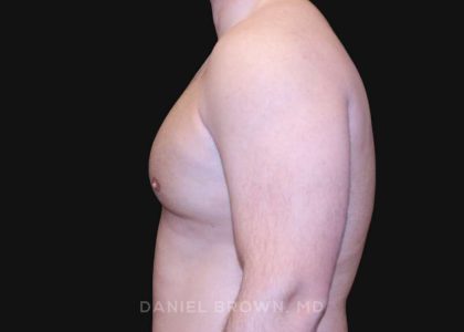 Gynecomastia Before & After Patient #10154