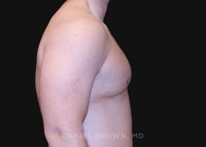 Gynecomastia Before & After Patient #10154