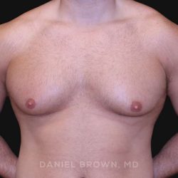 Gynecomastia Before & After Patient #10154