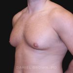 Gynecomastia Before & After Patient #10154