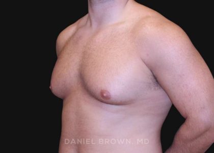 Gynecomastia Before & After Patient #10154