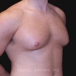 Gynecomastia Before & After Patient #10154