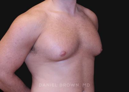Gynecomastia Before & After Patient #10154