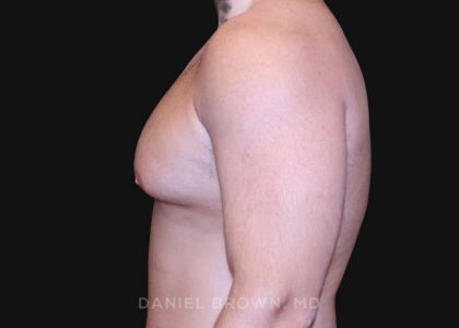 Gynecomastia Before & After Patient #10154