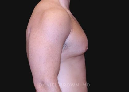 Gynecomastia Before & After Patient #10154