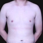 Gynecomastia Before & After Patient #10165