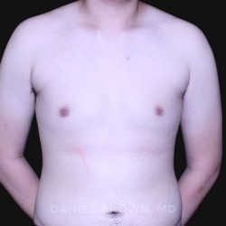 Gynecomastia Before & After Patient #10165