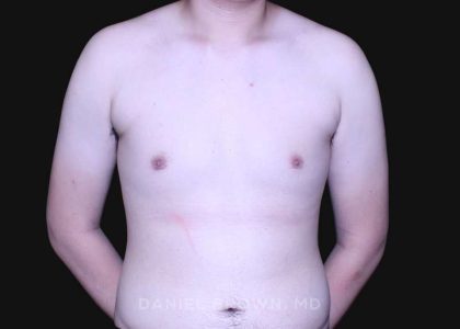 Gynecomastia Before & After Patient #10165