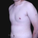Gynecomastia Before & After Patient #10165