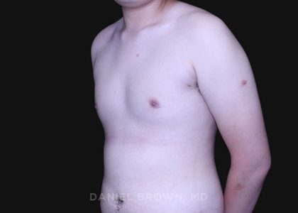 Gynecomastia Before & After Patient #10165