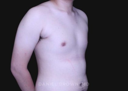 Gynecomastia Before & After Patient #10165