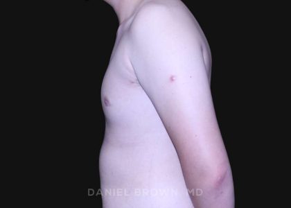 Gynecomastia Before & After Patient #10165