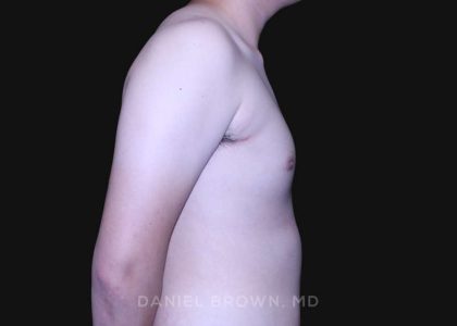 Gynecomastia Before & After Patient #10165