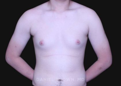 Gynecomastia Before & After Patient #10165