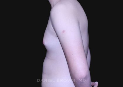 Gynecomastia Before & After Patient #10165