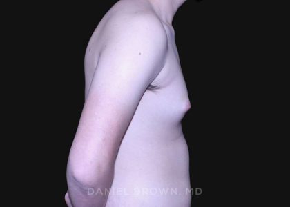 Gynecomastia Before & After Patient #10165