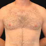 Gynecomastia Before & After Patient #10176
