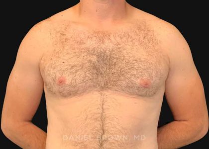 Gynecomastia Before & After Patient #10176
