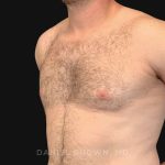 Gynecomastia Before & After Patient #10176