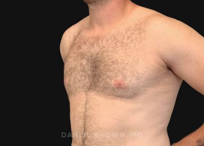 Gynecomastia Before & After Patient #10176