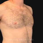Gynecomastia Before & After Patient #10176