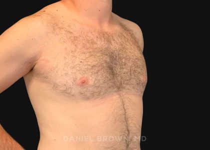 Gynecomastia Before & After Patient #10176