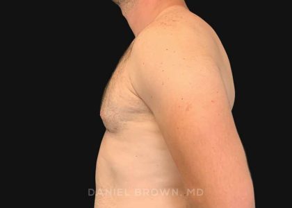 Gynecomastia Before & After Patient #10176
