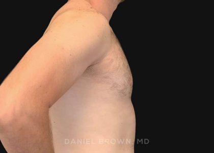 Gynecomastia Before & After Patient #10176