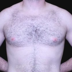 Gynecomastia Before & After Patient #10176