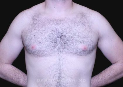 Gynecomastia Before & After Patient #10176