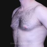 Gynecomastia Before & After Patient #10176