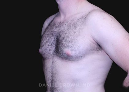 Gynecomastia Before & After Patient #10176