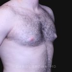 Gynecomastia Before & After Patient #10176