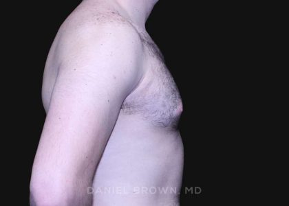 Gynecomastia Before & After Patient #10176