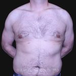 Gynecomastia Before & After Patient #10187