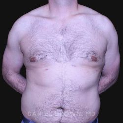 Gynecomastia Before & After Patient #10187