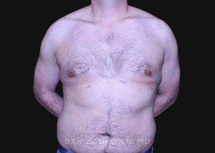 Gynecomastia Before & After Patient #10187