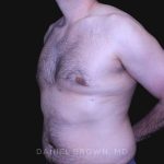 Gynecomastia Before & After Patient #10187